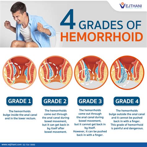 does hemorrhoids leak|What Do Hemorrhoids Look Like: Types and More